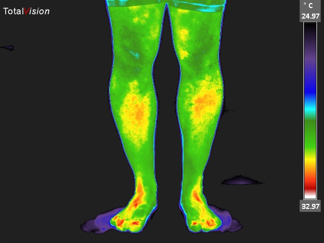 Thermal image of lower legs.